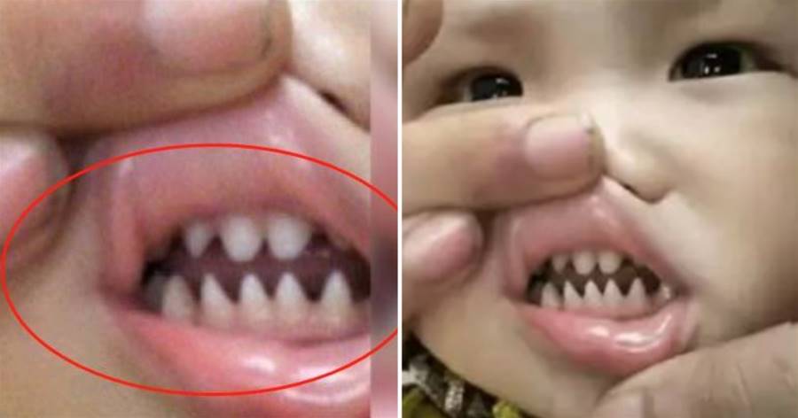 5歲女寶滿口「鯊魚牙」，父母拍照發網被笑翻「妳女兒有貴族血統，網友：父母太不負責任了！